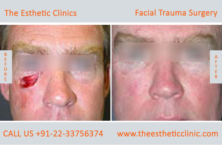 Facial Trauma surgery, Maxillofacial Reconstruction Surgery before after photos in mumbai india (5)